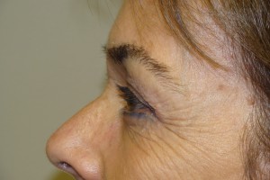 Blepharoplasty Before and After 07 | Sanjay Grover MD FACS