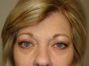 Blepharoplasty Before and After 33 | Sanjay Grover MD FACS