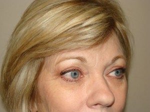 Blepharoplasty Before and After 08 | Grover Aesthetics