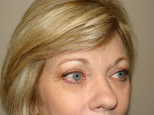 Blepharoplasty Before and After 08 | Sanjay Grover MD FACS