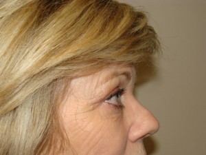 Blepharoplasty Before and After 08 | Sanjay Grover MD FACS