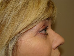 Blepharoplasty Before and After 08 | Sanjay Grover MD FACS