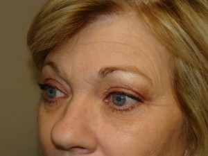 Blepharoplasty Before and After 08 | Sanjay Grover MD FACS