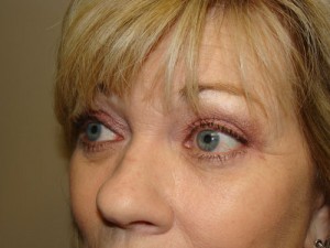 Blepharoplasty Before and After 08 | Sanjay Grover MD FACS