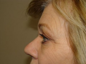 Blepharoplasty Before and After 08 | Grover Aesthetics