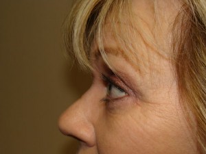 Blepharoplasty Before and After 08 | Sanjay Grover MD FACS