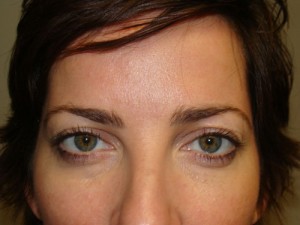 Blepharoplasty Before and After | Grover Aesthetics