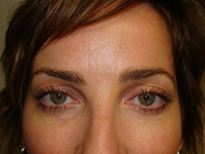 Blepharoplasty Before and After 09 | Sanjay Grover MD FACS