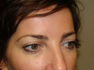 Blepharoplasty Before and After 09 | Grover Aesthetics