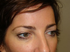 Blepharoplasty Before and After 09 | Sanjay Grover MD FACS