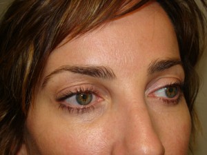 Blepharoplasty Before and After 09 | Sanjay Grover MD FACS