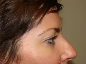 Blepharoplasty Before and After 09 | Sanjay Grover MD FACS