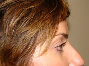 Blepharoplasty Before and After 09 | Grover Aesthetics