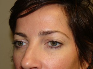 Blepharoplasty Before and After 09 | Sanjay Grover MD FACS