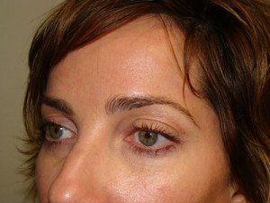 Blepharoplasty Before and After 09 | Grover Aesthetics