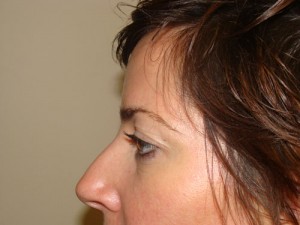 Blepharoplasty Before and After 09 | Sanjay Grover MD FACS