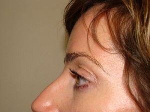 Blepharoplasty Before and After 09 | Sanjay Grover MD FACS