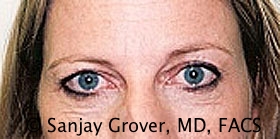Blepharoplasty Before and After | Grover Aesthetics