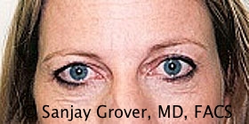 Blepharoplasty Before and After 36 | Sanjay Grover MD FACS