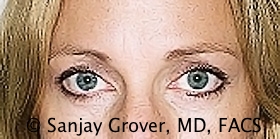 Blepharoplasty Before and After 10 | Sanjay Grover MD FACS