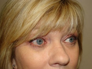 Blepharoplasty Before and After 10 | Grover Aesthetics