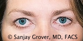 Blepharoplasty Before and After | Grover Aesthetics