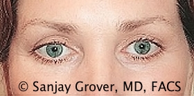 Blepharoplasty Before and After | Grover Aesthetics