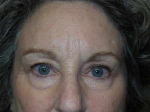 Blepharoplasty Before and After | Grover Aesthetics