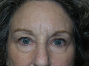 Blepharoplasty Before and After | Sanjay Grover MD FACS