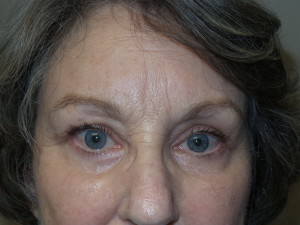 Blepharoplasty Before and After 12 | Sanjay Grover MD FACS