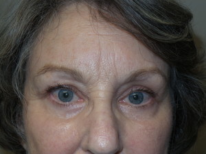 Blepharoplasty Before and After | Grover Aesthetics