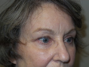 Blepharoplasty Before and After 12 | Grover Aesthetics