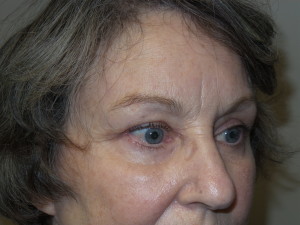 Blepharoplasty Before and After 12 | Sanjay Grover MD FACS