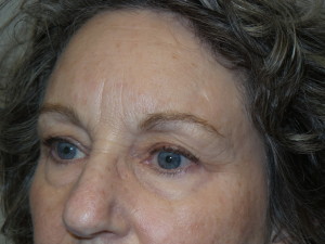 Blepharoplasty Before and After 12 | Sanjay Grover MD FACS