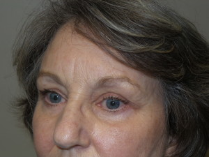 Blepharoplasty Before and After 12 | Sanjay Grover MD FACS