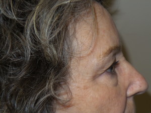 Blepharoplasty Before and After 12 | Grover Aesthetics