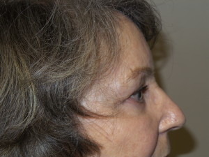 Blepharoplasty Before and After 12 | Sanjay Grover MD FACS