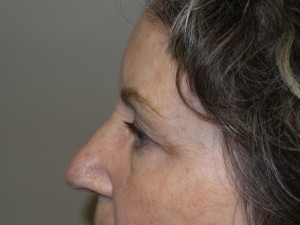 Blepharoplasty Before and After 12 | Sanjay Grover MD FACS