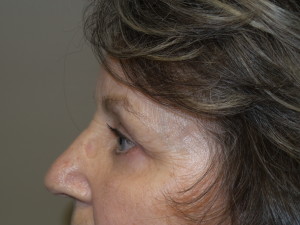Blepharoplasty Before and After 12 | Grover Aesthetics