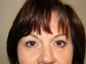 Blepharoplasty Before and After 13 | Sanjay Grover MD FACS