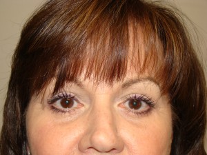 Blepharoplasty Before and After | Grover Aesthetics