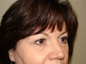 Blepharoplasty Before and After 13 | Sanjay Grover MD FACS