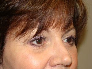 Blepharoplasty Before and After 13 | Grover Aesthetics