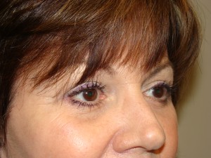 Blepharoplasty Before and After 13 | Sanjay Grover MD FACS