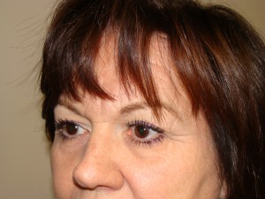 Blepharoplasty Before and After 13 | Grover Aesthetics