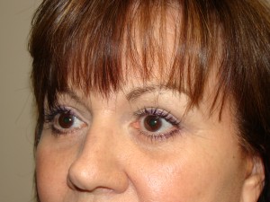 Blepharoplasty Before and After 13 | Sanjay Grover MD FACS