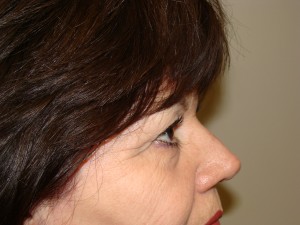 Blepharoplasty Before and After 13 | Grover Aesthetics
