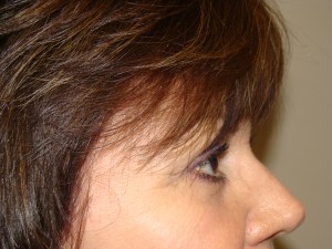 Blepharoplasty Before and After 13 | Grover Aesthetics
