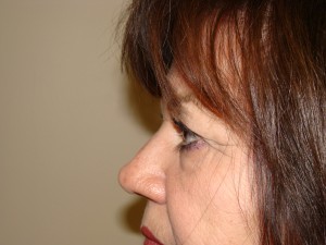 Blepharoplasty Before and After 13 | Grover Aesthetics