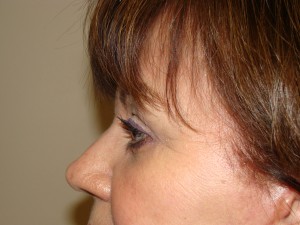 Blepharoplasty Before and After 13 | Grover Aesthetics